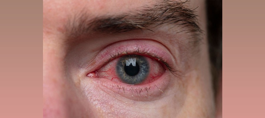 باید خشکی چشم را جدی بگیریم؟