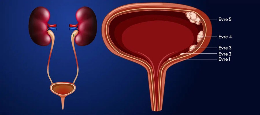 تشخیص و درمان سرطان های سیستم ادراری