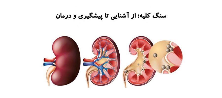 سنگ کلیه؛ از آشنایی تا پیشگیری و درمان