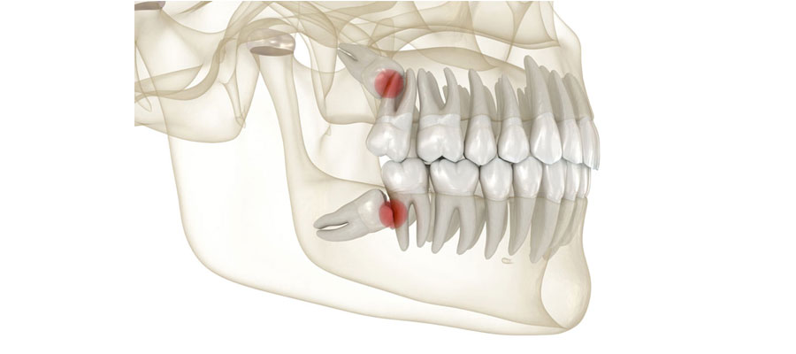 چرایی توجه به دندان عقل